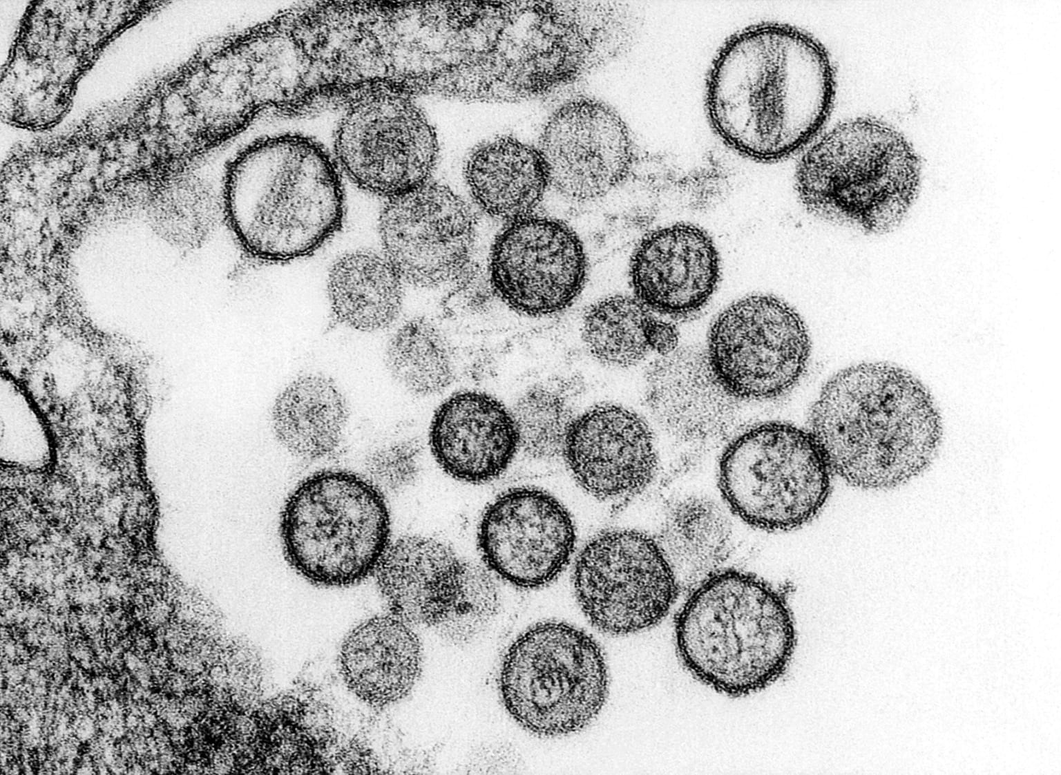 Hantavirus Pulmonary Syndrome