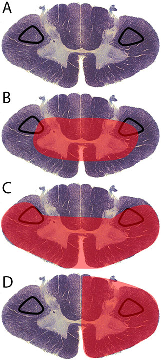 <p>Patterns of Incomplete Spinal Cord Injury