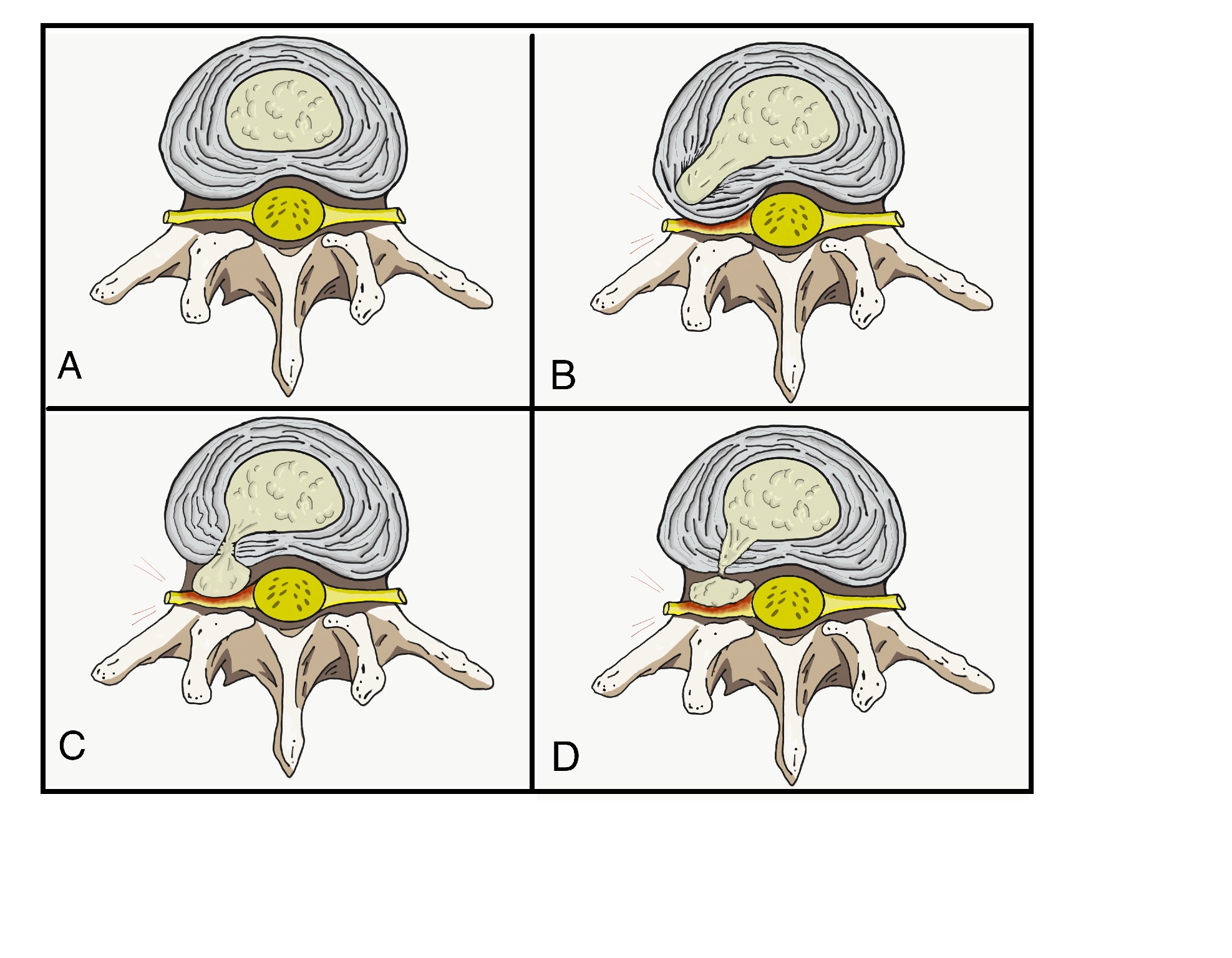 <p>Stages of Nucleus Pulposus Herniation