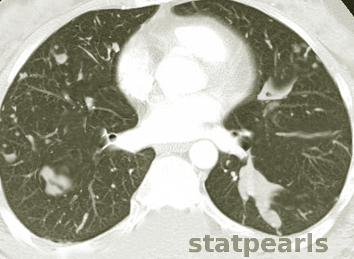<p>Central Bronchiectasis and Mucoid Impaction