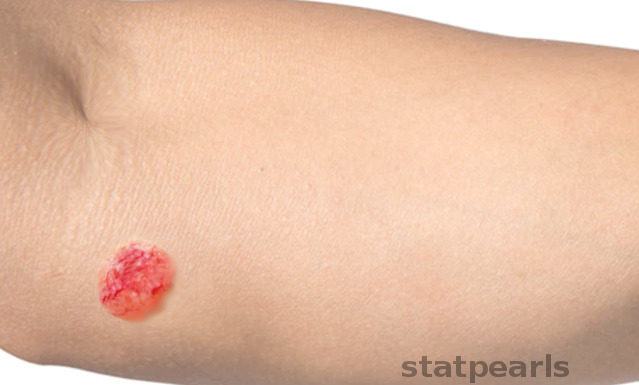 <p>Clear-Cell Acanthoma.</p>
