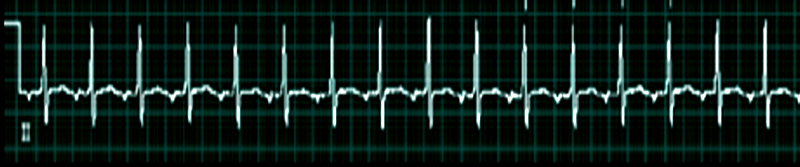 <p>Atrial Tachycardia.</p>