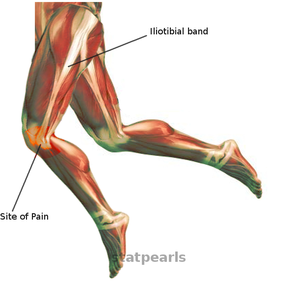 <p>ITB Friction Syndrome.</p>