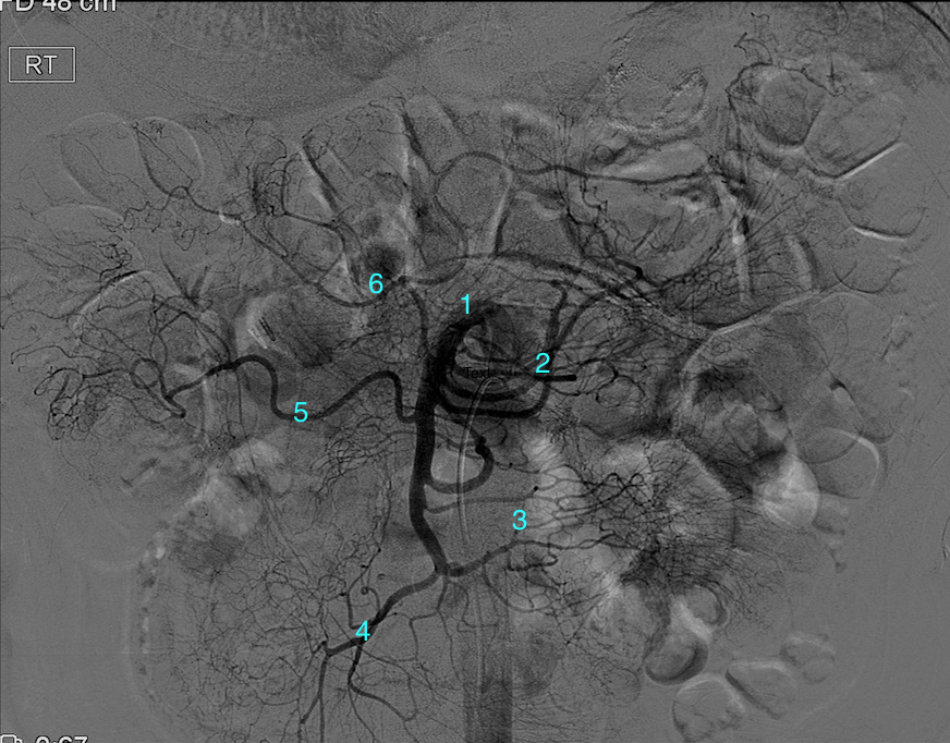 <p>Angiogram of the Superior Mesenteric Artery
