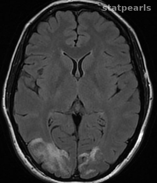 <p>Balint Syndrome.</p>