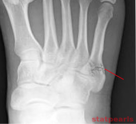 <p>Jones Fracture.</p>