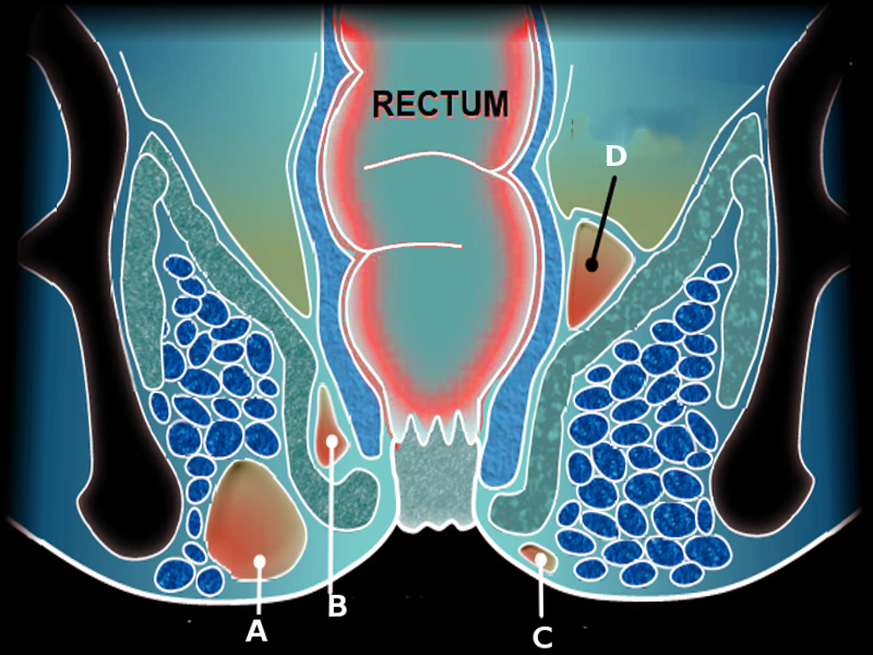 <p>Perirectal Abscess.</p>