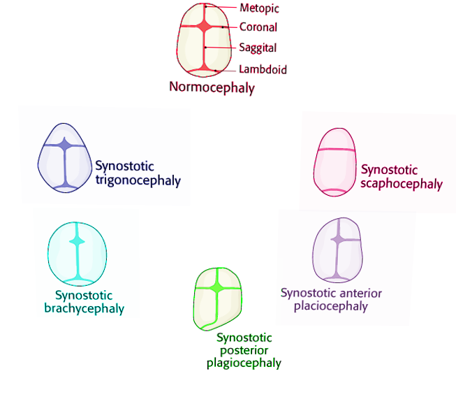 <p>Craniosynostosis