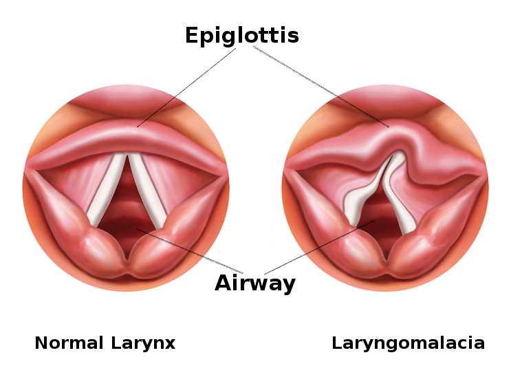 <p>Laryngomalacia.</p>