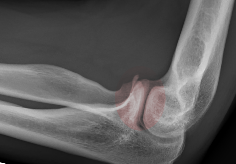 <p>Coronoid Fracture.</p>