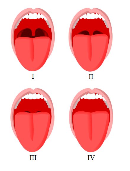<p>Mallampati Score Classification