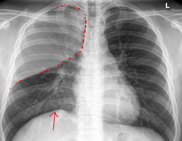 <p>Postsurgical Atelectasis.</p>
