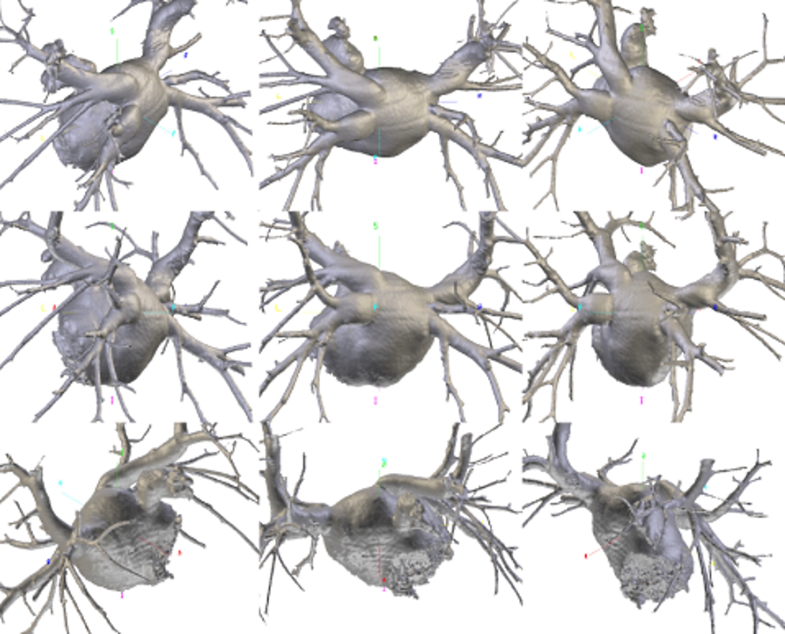 <p>Pulmonary Vein Variants on Multiplanar Computed Tomography Reconstruction
