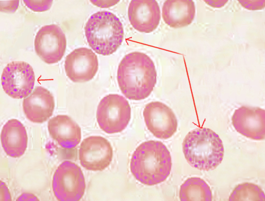 <p>Basophilic Stipling.</p>