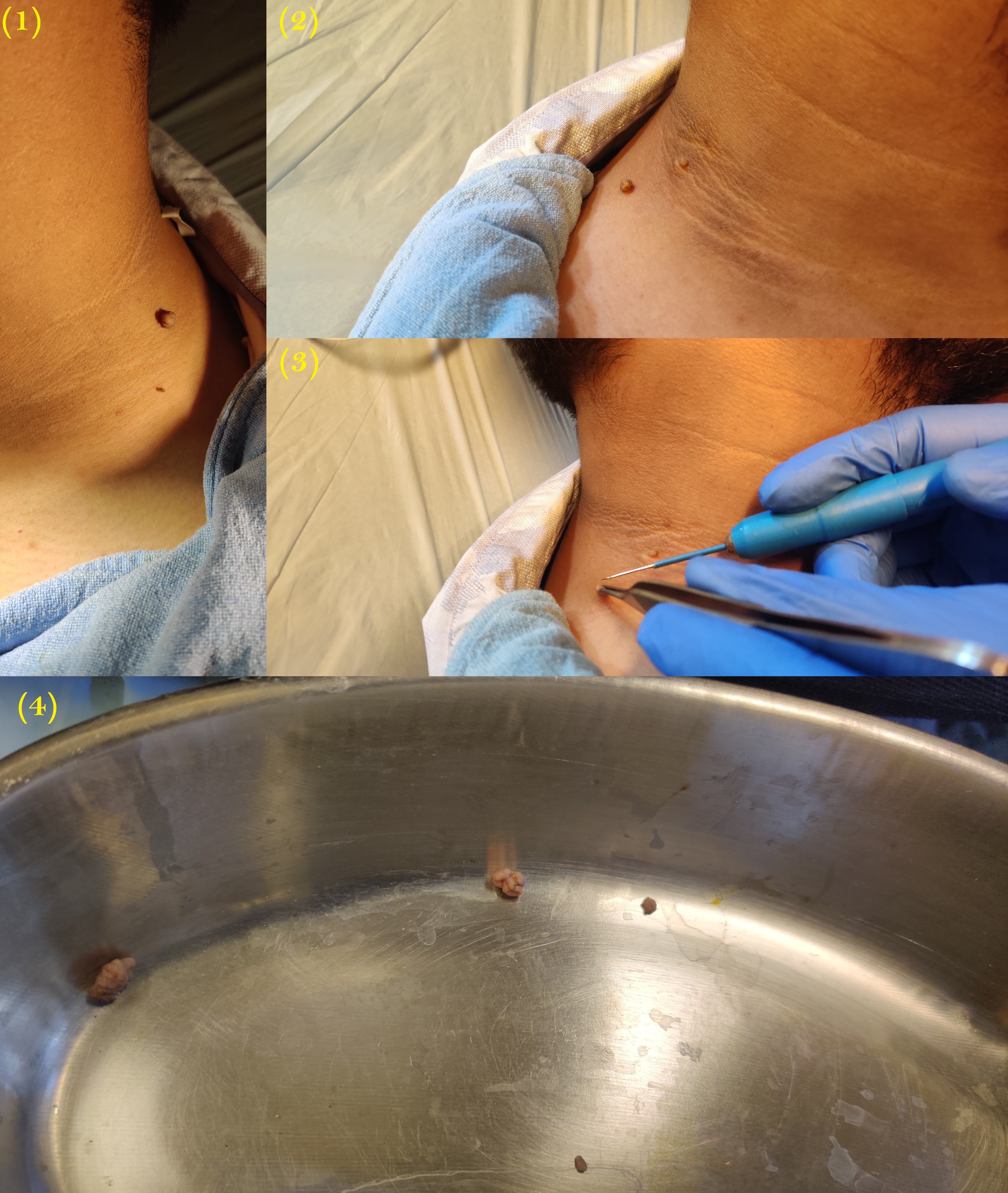 <p>Skin Tag Removal Using Radiocautery