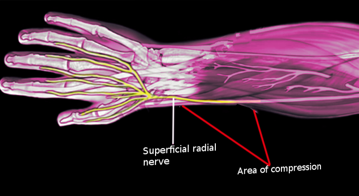 <p>Cheiralgia Paresthetica