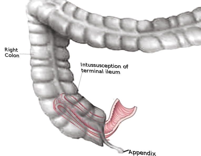<p>Intussusception of Small Bowel