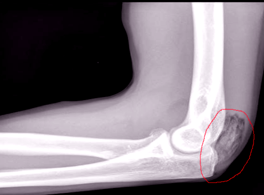 <p>Heterotopic Ossification, Radiograph