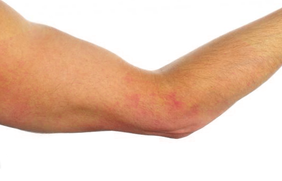 <p>Brachioradial Pruritus