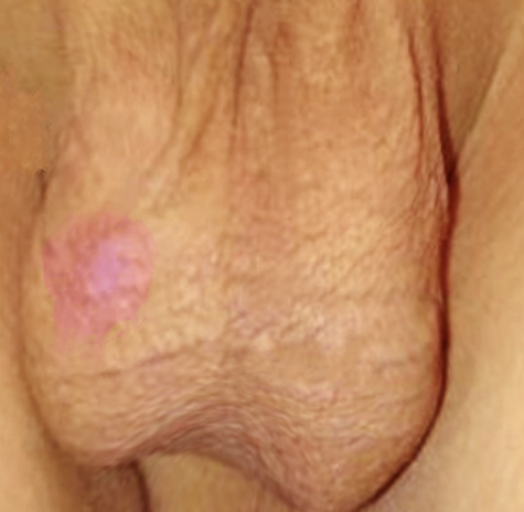 <p>Blue-Dot Sign. The image depicts a blue-dot sign on the scrotum of a pediatric patient.</p>