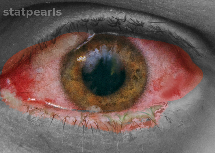 <p>Bacterial Conjunctivitis