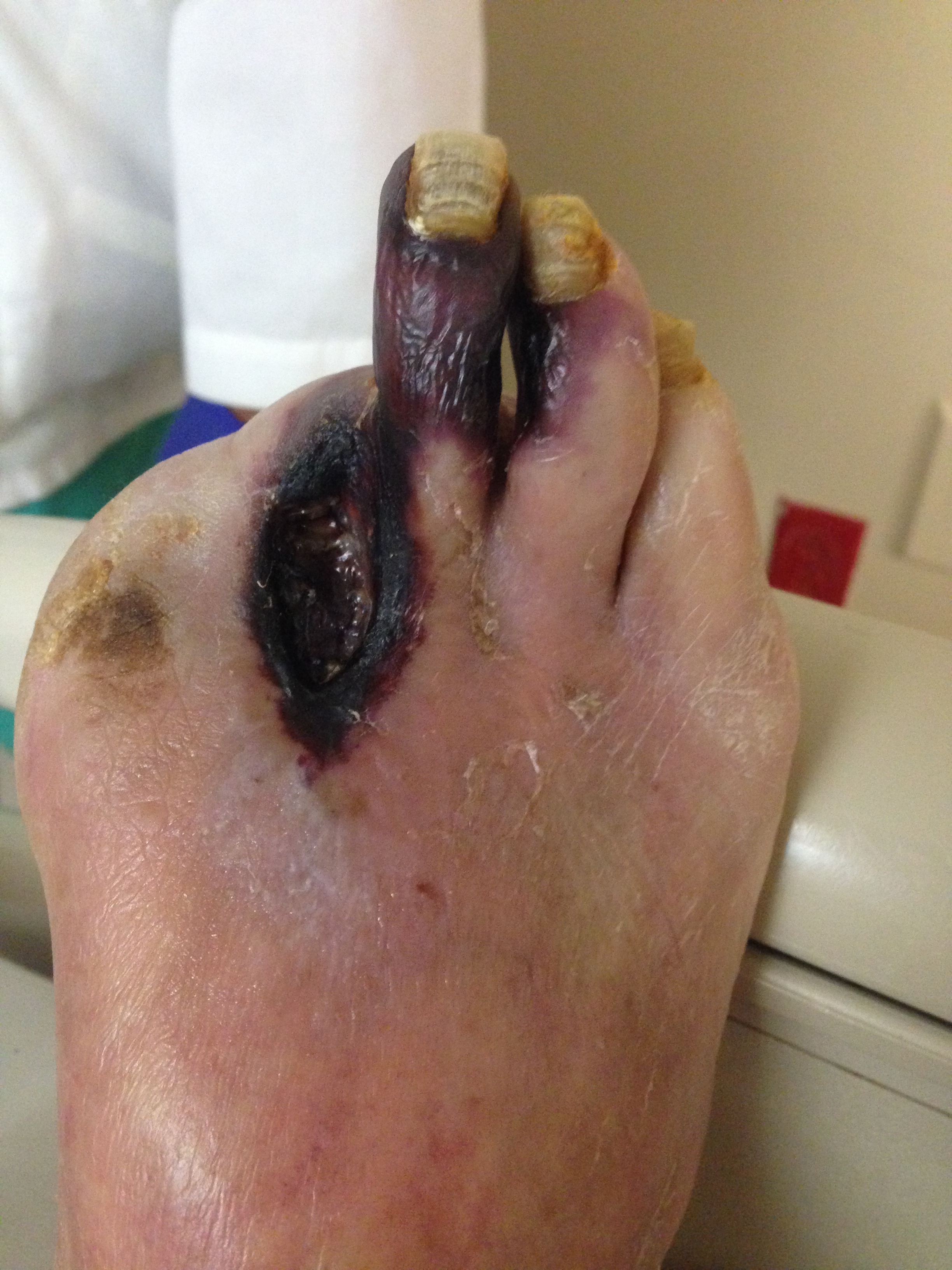<p>Gangrenous Ulcers