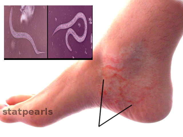 <p>Hookworm Infection