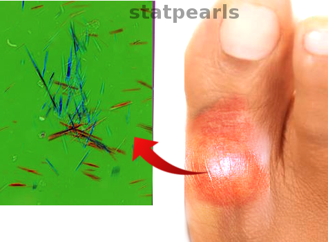 <p>Monosodium Urate Crystals and Acute Gouty Inflammation