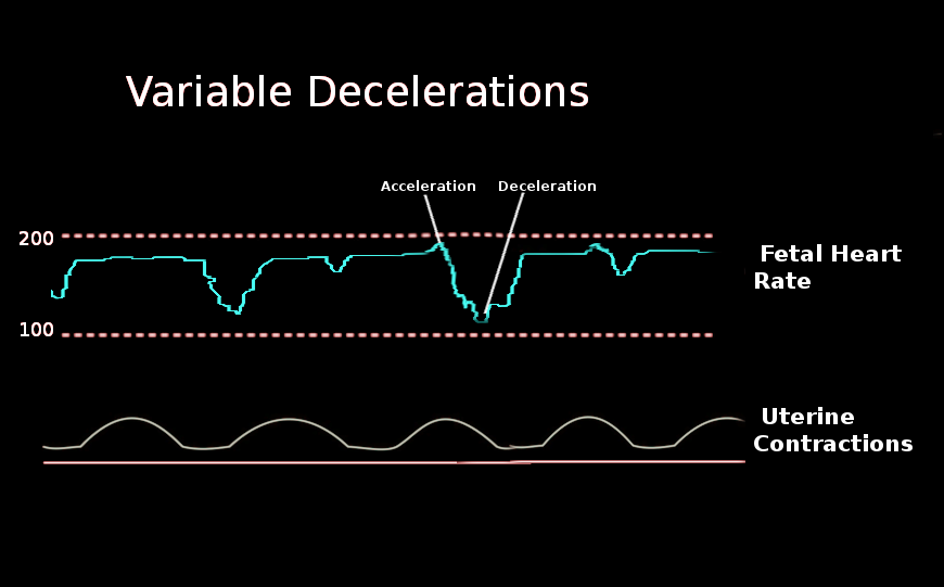 <p>Variable Decelerations. A variable deceleration is a visually apparent, abrupt decrease in fetal heart rate.</p>