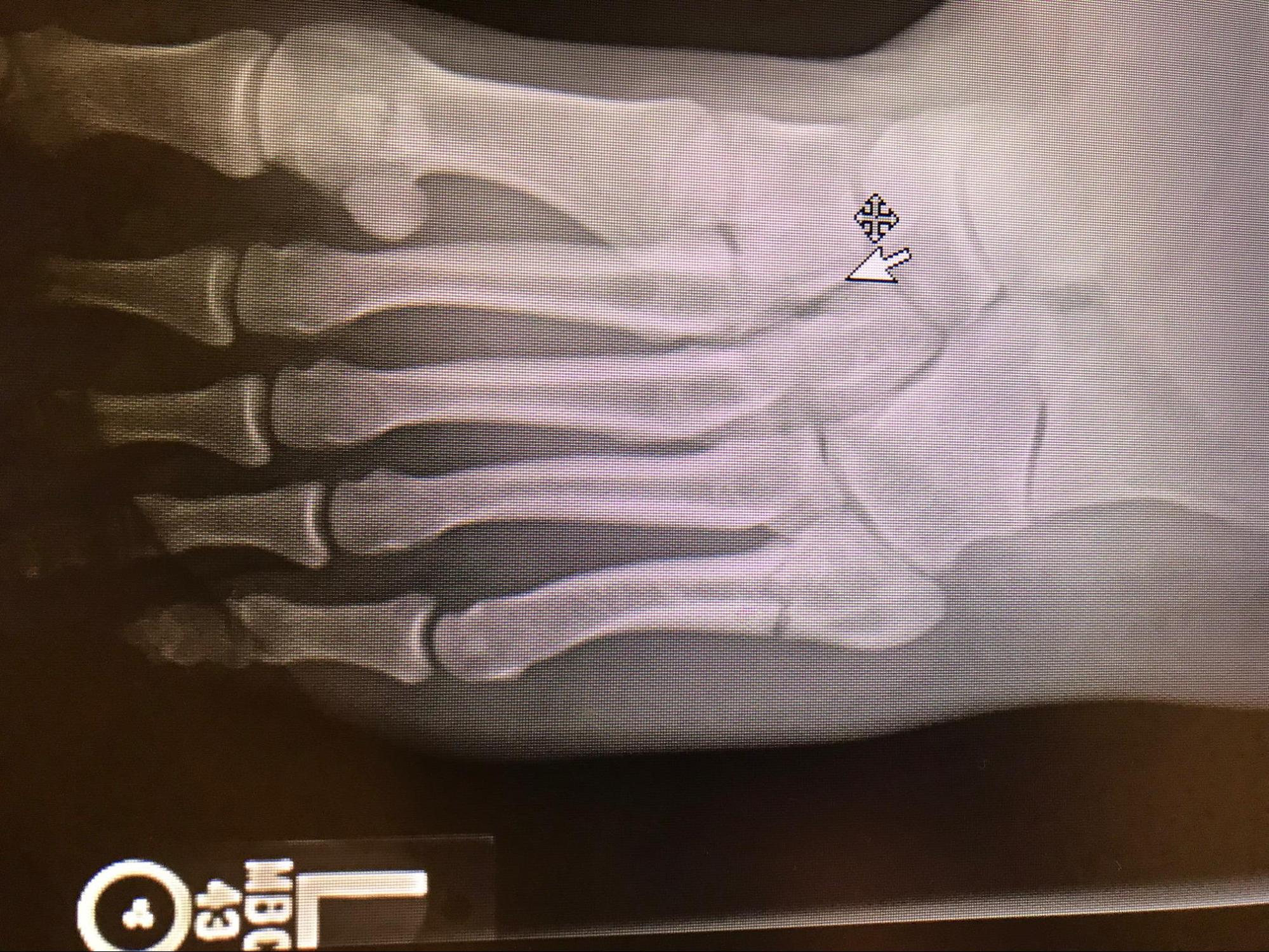 <p>Radiograph of a Classic Jones Fracture