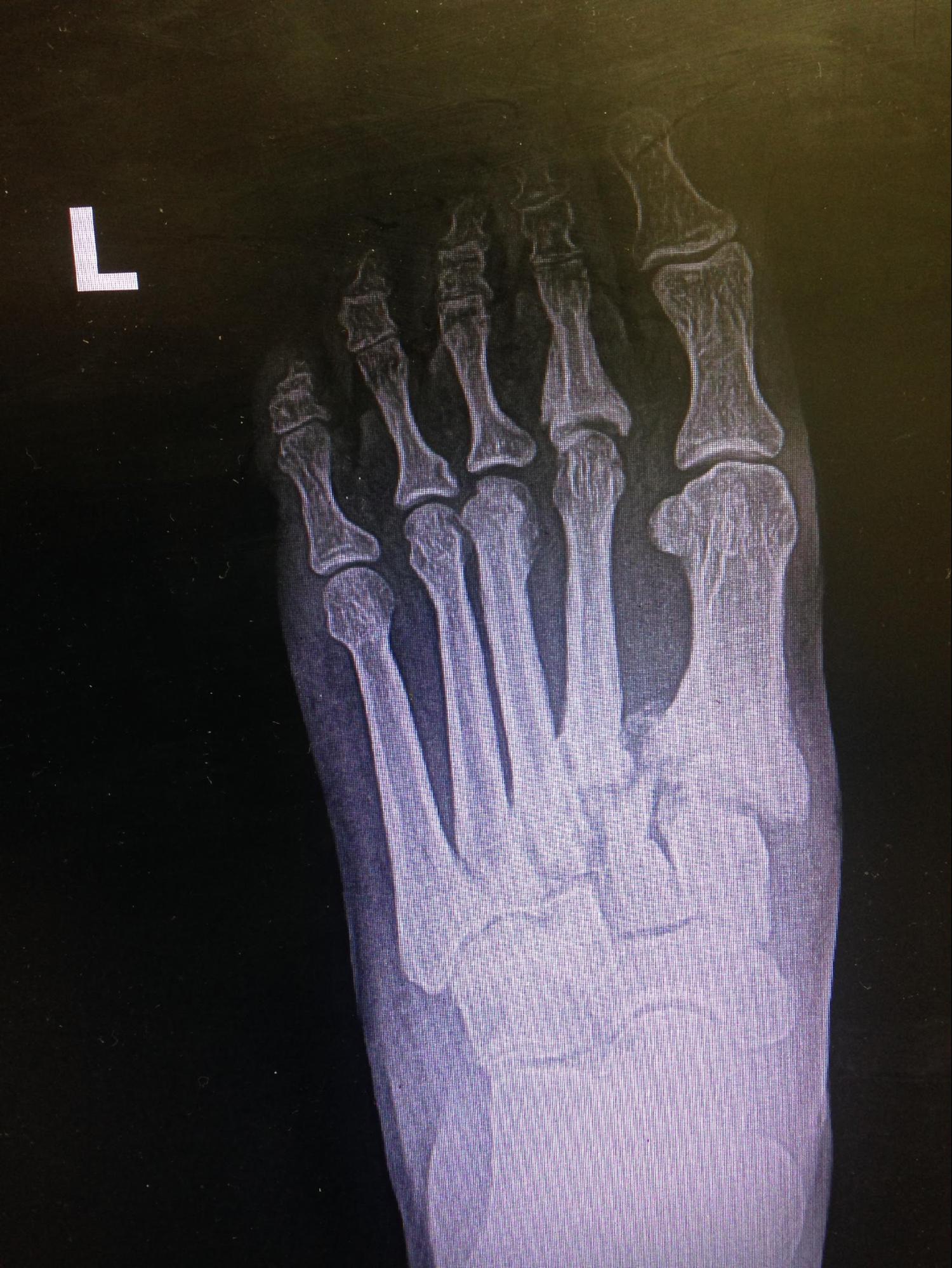 <p>Lisfranc Fracture-Dislocation of the Left Foot