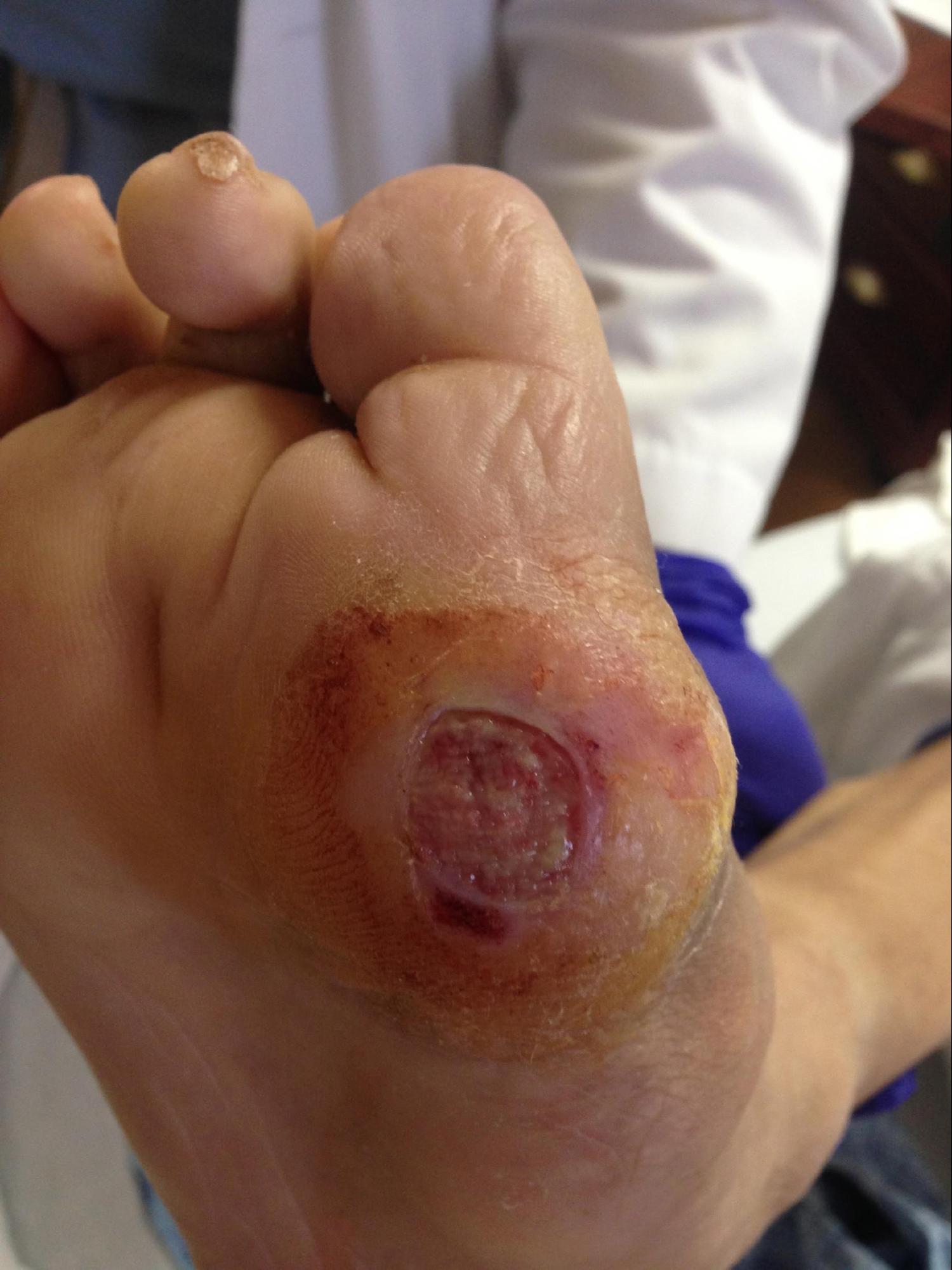 <p>Diabetic Ulcer