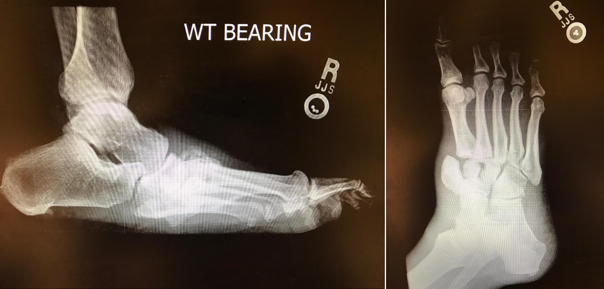 <p>Charcot Neuropathic Osteoarthropathy