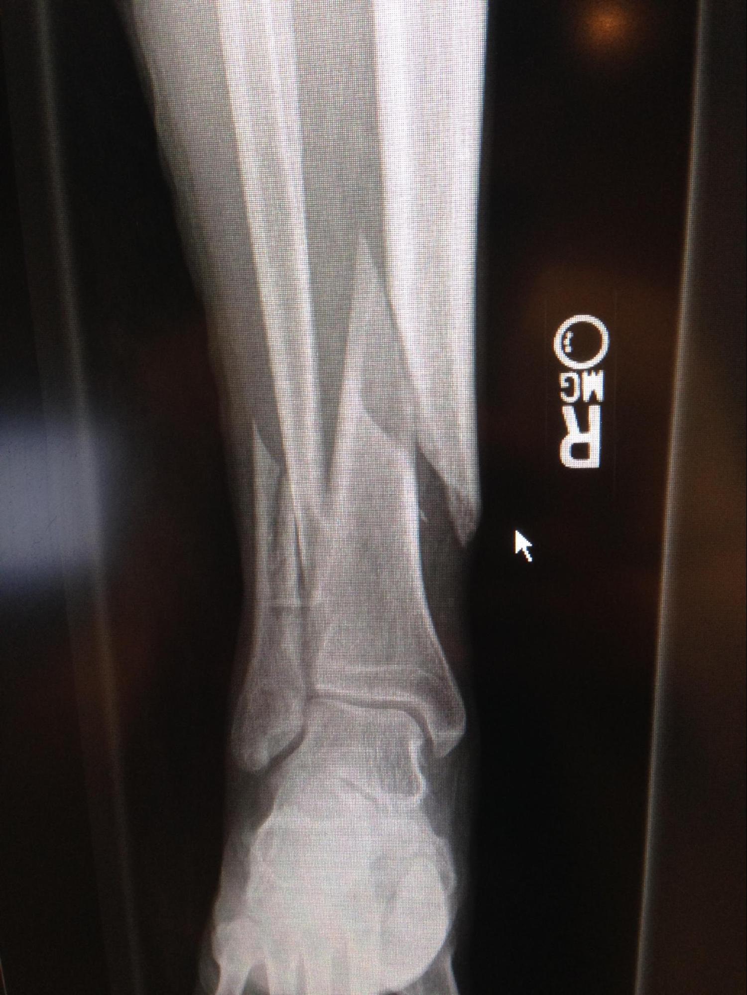 Tibial Fracture
Spiral fracture of the distal one-third tibia and fibula.