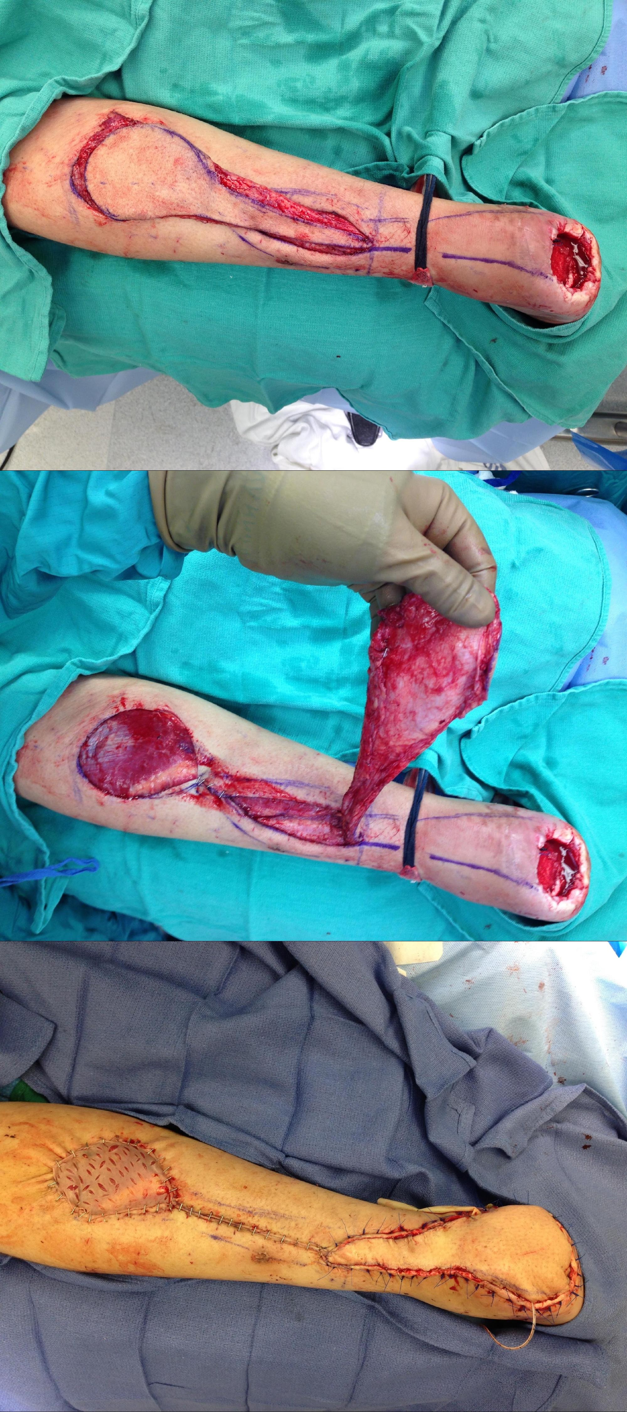 <p>Reverse Sural Artery Flap. This rotation flap is being used to reconstruct a nonhealing heel ulcer.</p>