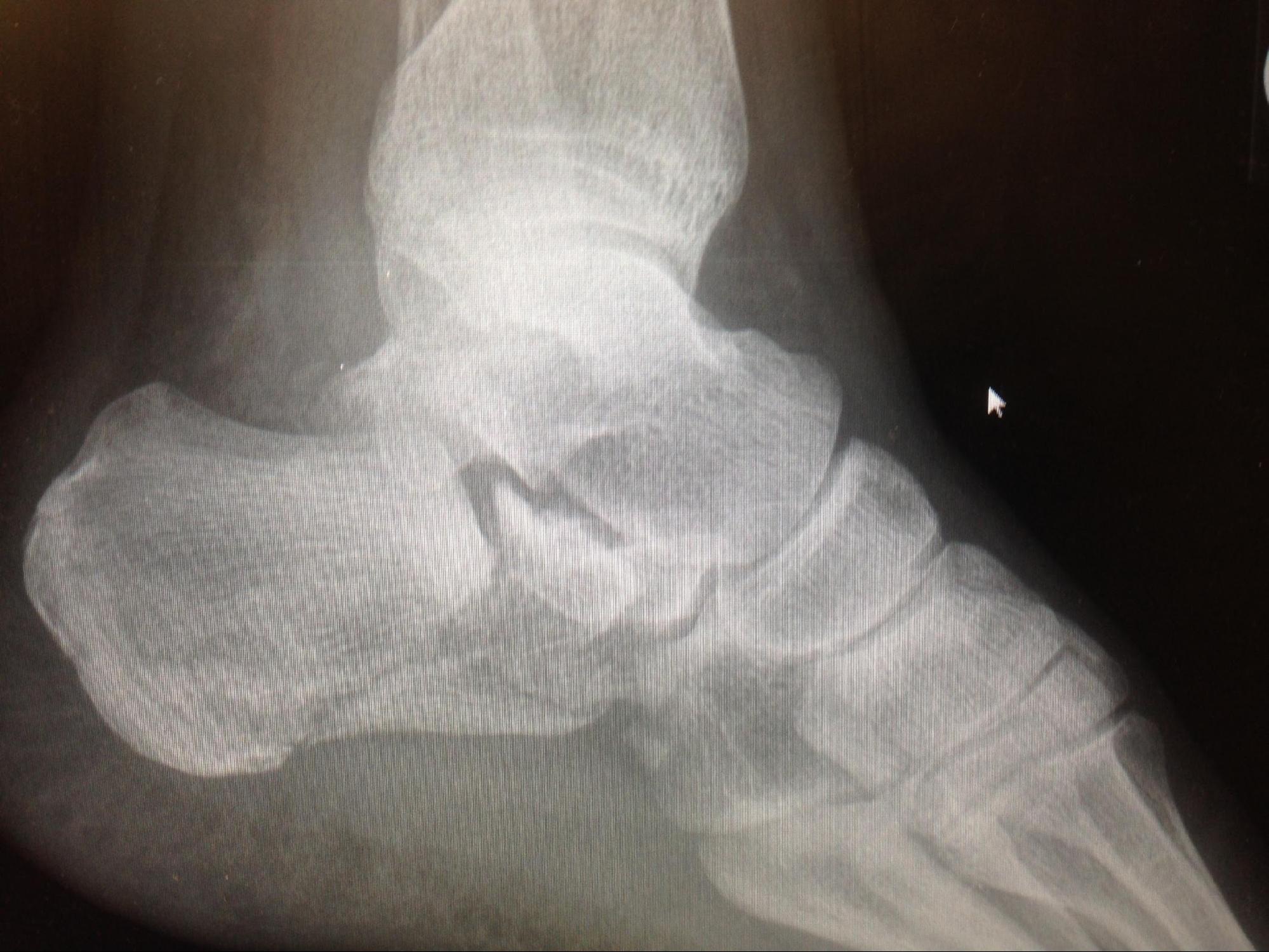 <p>Intraarticular Calcaneus Fracture with Subtalar Joint Depression