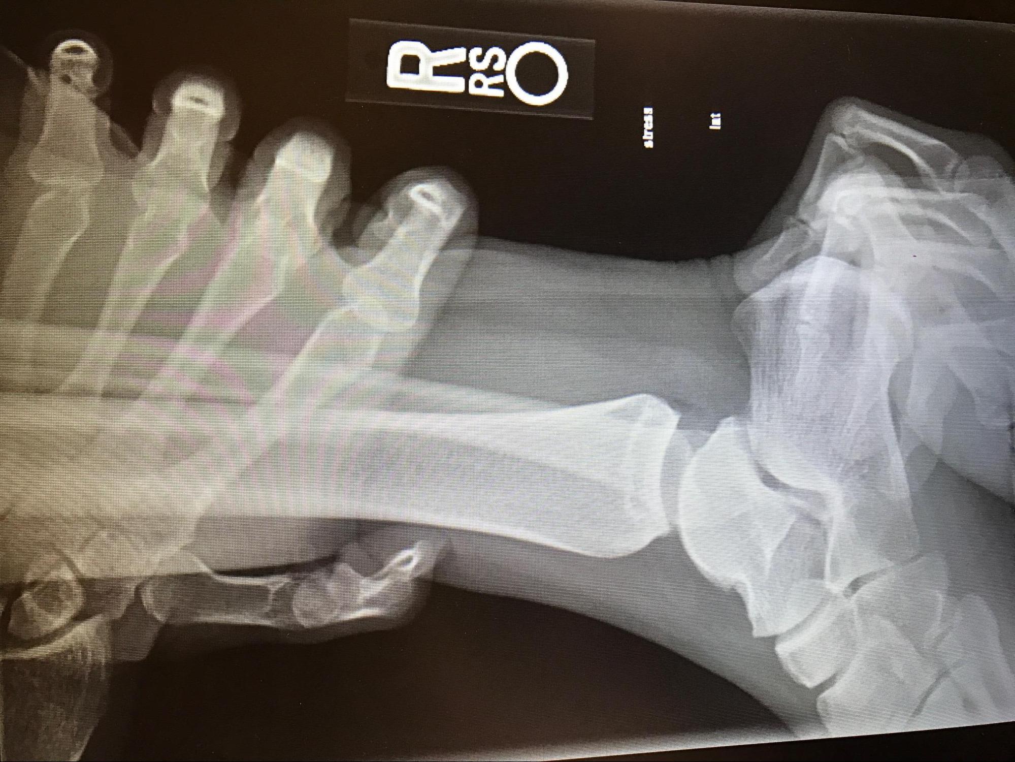 <p>Grade III Acute Ankle Sprain, Anterior Drawer Test, Radiograph