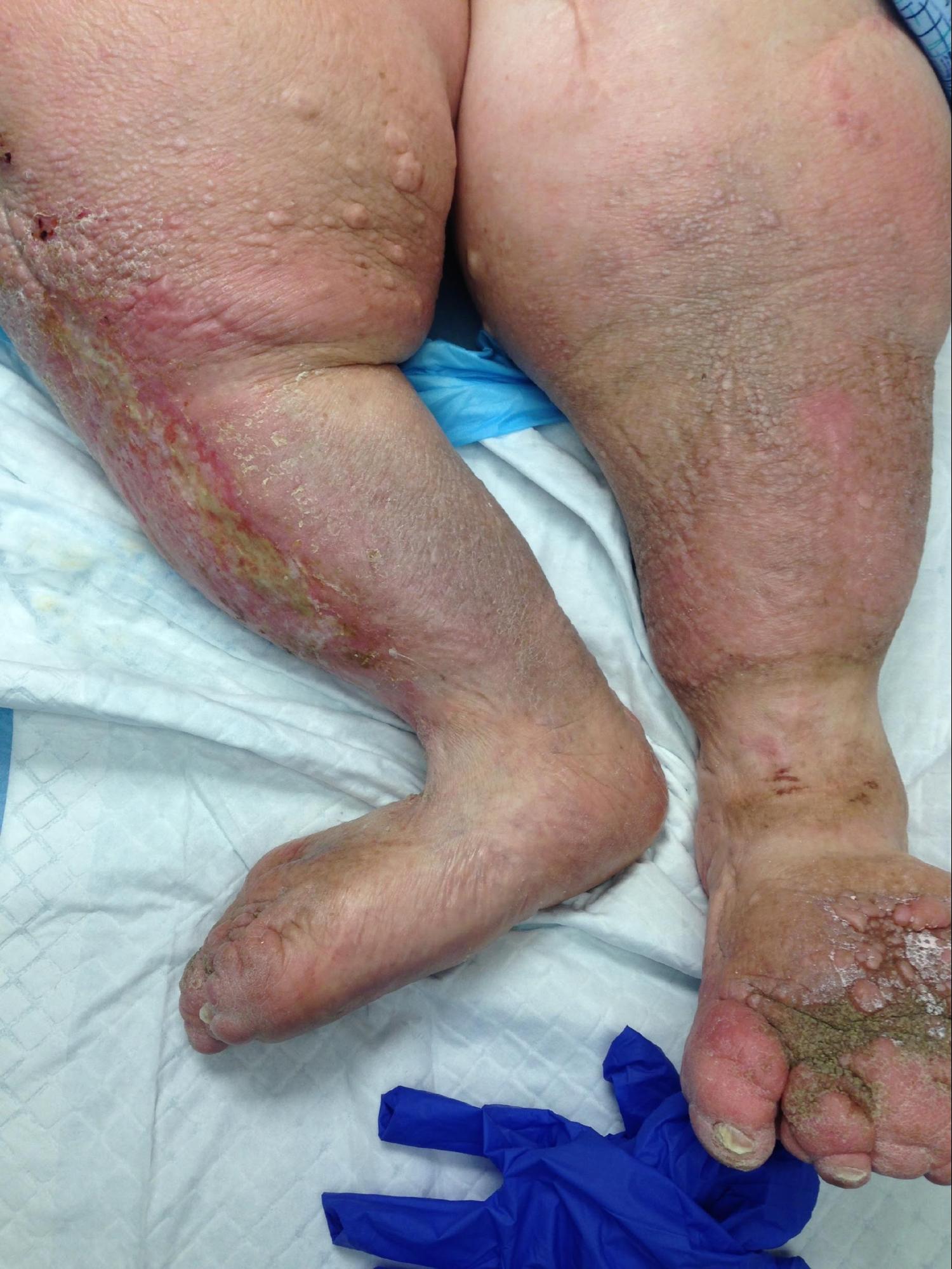 <p>Stage 3 Lymphedema of the Bilateral Lower Extremities