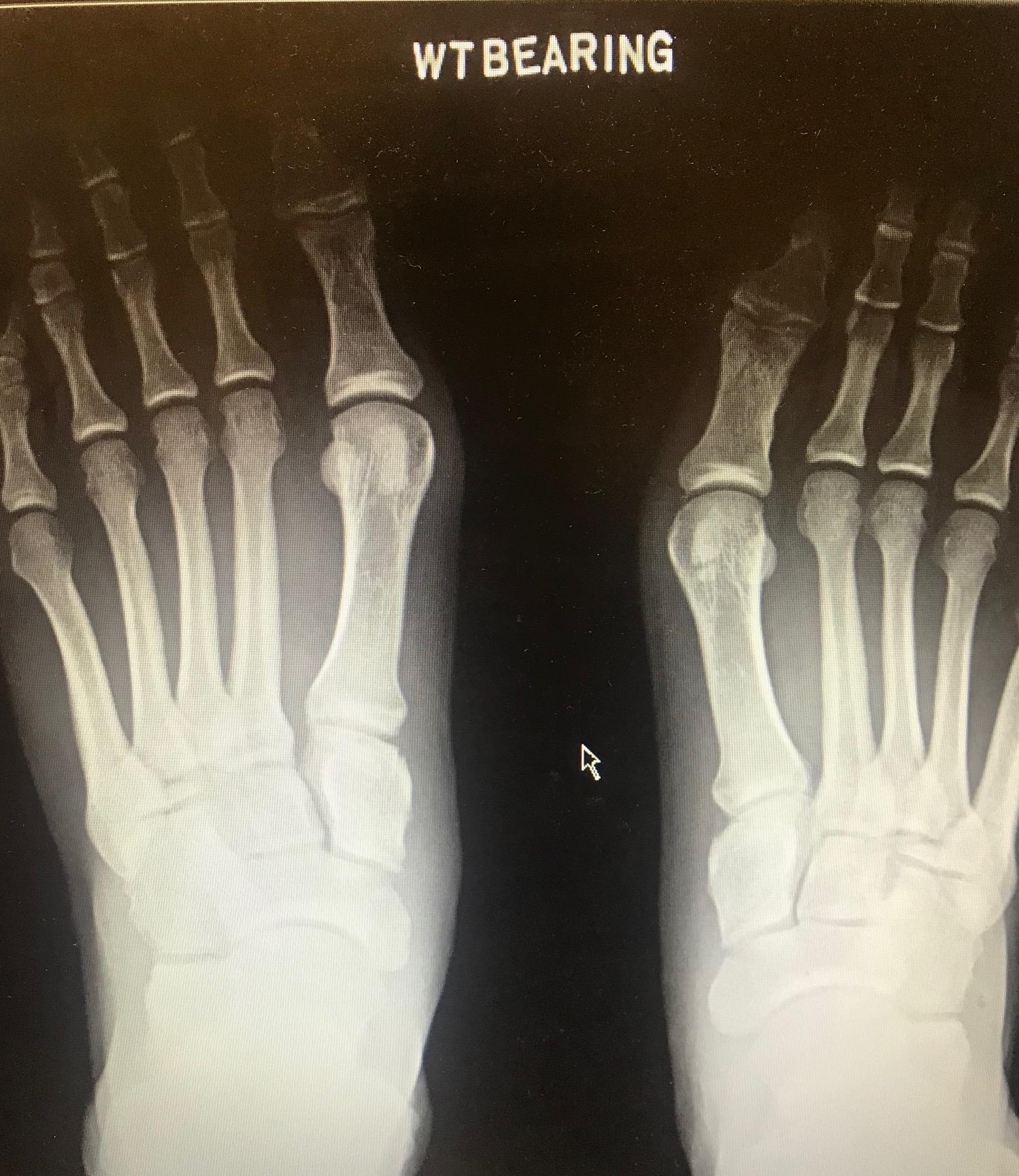 <p>Lisfranc Dislocation on Bilateral Weight-Bearing X-Ray
