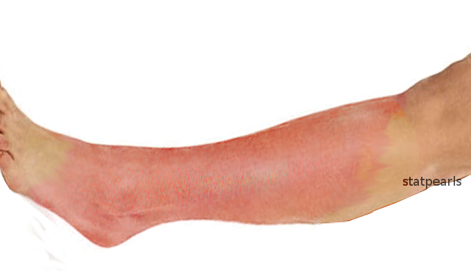 <p>&nbsp;Cellulitis of the Extremity