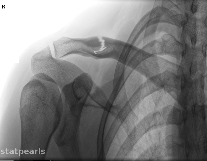 <p>Clavicle Fracture</p>