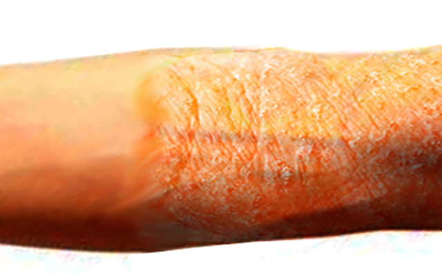 <p>Atopic Dermatitis.</p>