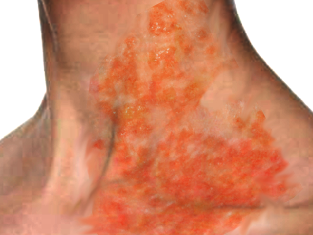 <p>Kaposi Varicelliform Eruption in a Patient With Atopic Dermatitis