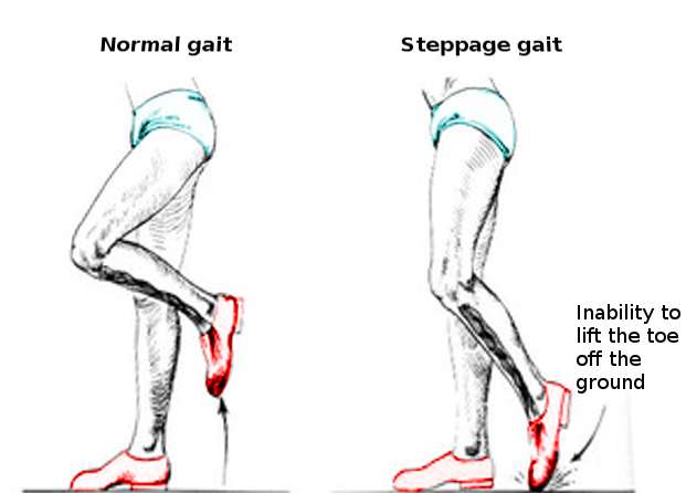 <p>Steppage Gait. This image shows a steppage gait, highlighting the inability to lift the toe off the ground.</p>