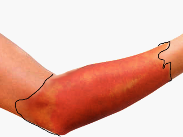 <p>Erysipelas