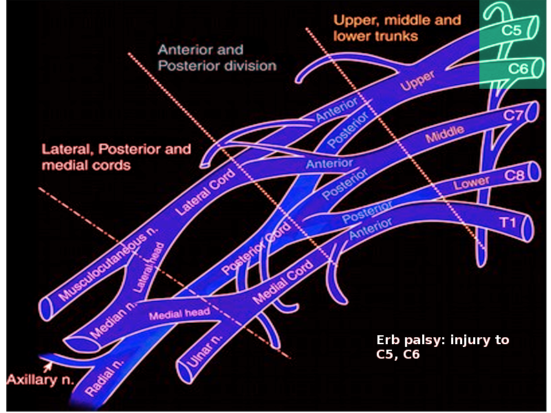 <p>Erb Palsy-Brachial Plexus