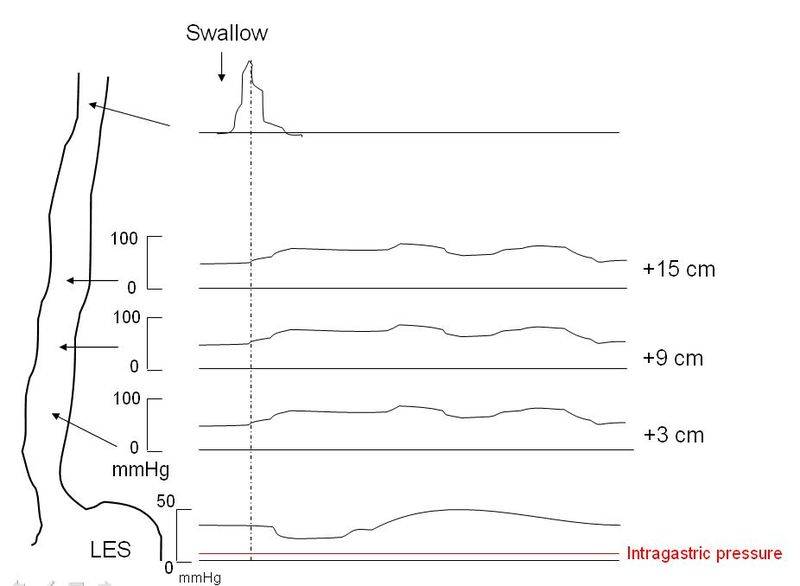 <p>Achalasia Manometry