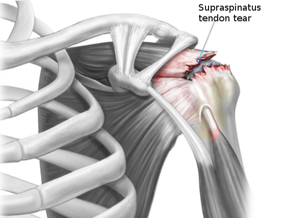 <p>Rotator Cuff Tear