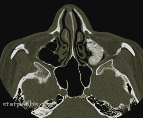 <p>Acute Sinusitis