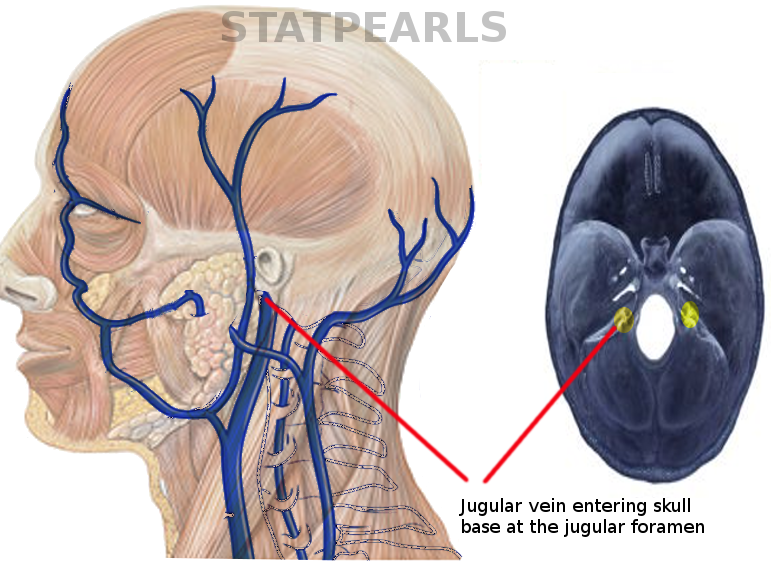 <p>Jugular Foramen. This image shows the jugular vein entering the skull base at the jugular foramen.</p>